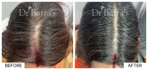 Hair Falling Treatment